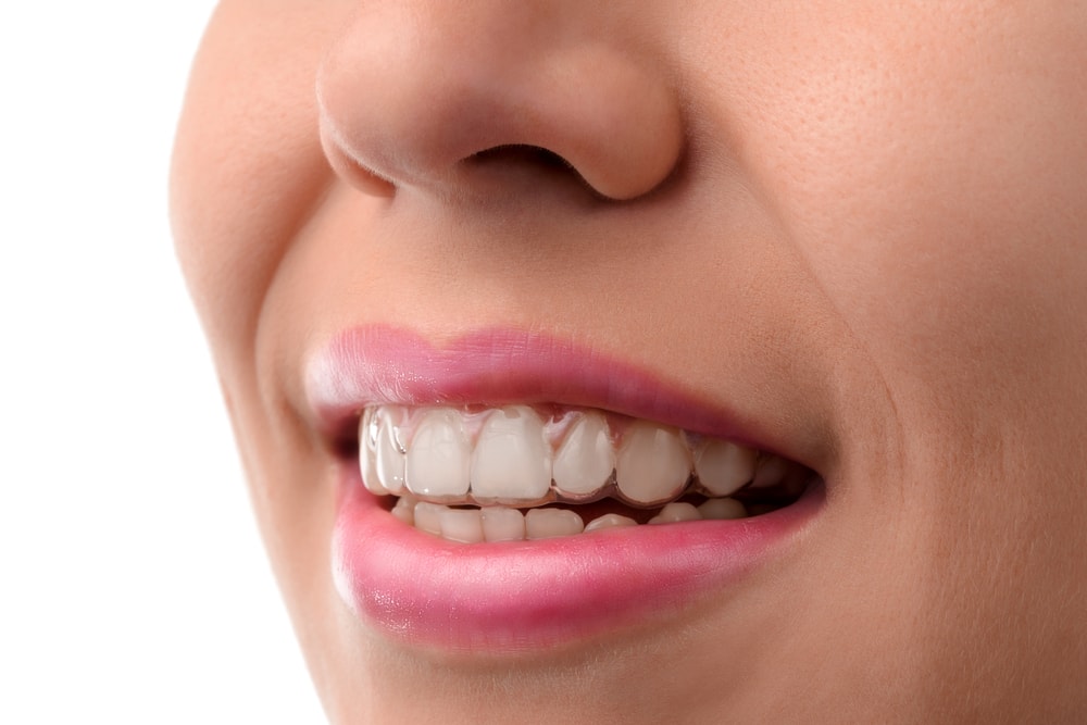 AN ORTHODONTIC SOLUTION THAT UPHOLDS ORAL WELLNESS-min