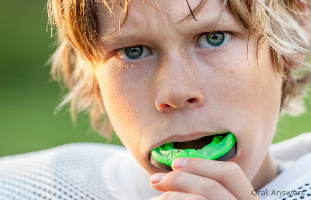 How Mouthguards Can Protect you from Dental Injuries-min
