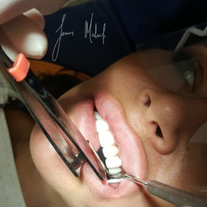 Cosmetic Dentistry Brisbane Dentist - Dr James Malouf - Emma Rose
