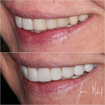 Porcelain Veneers