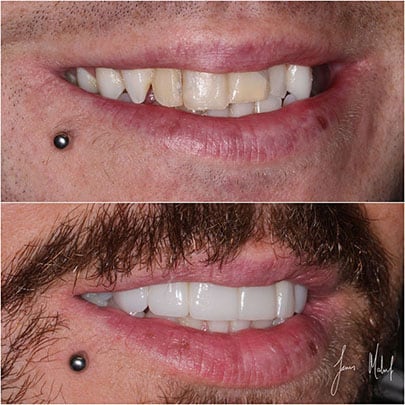 Porcelain Veneers