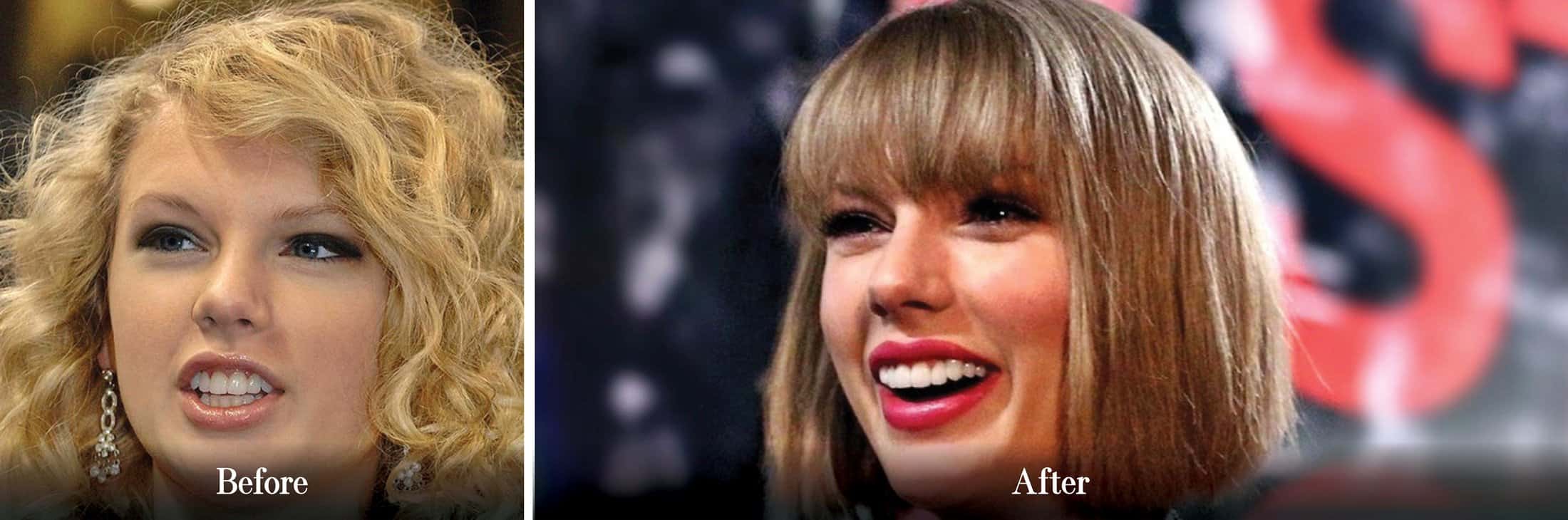 taylor swift before and after veneers