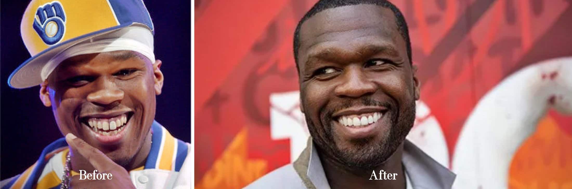 50 cent veneers