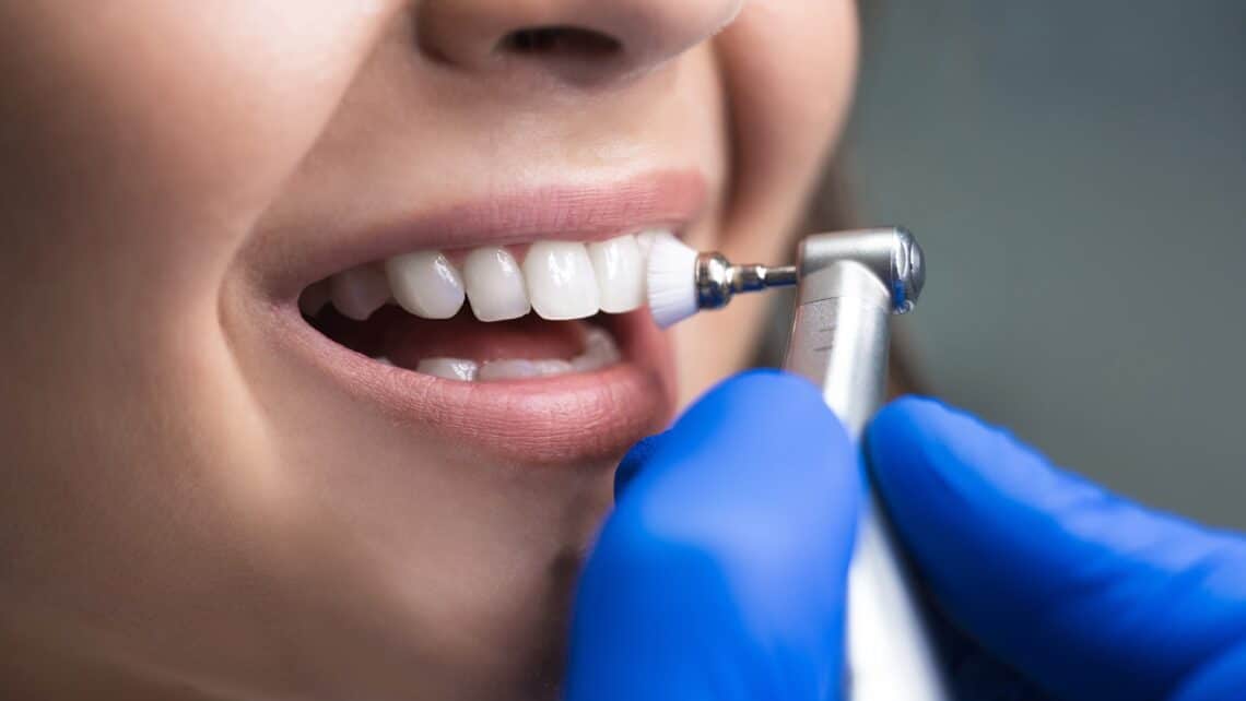 How Often Should I Have My Teeth Cleaned?